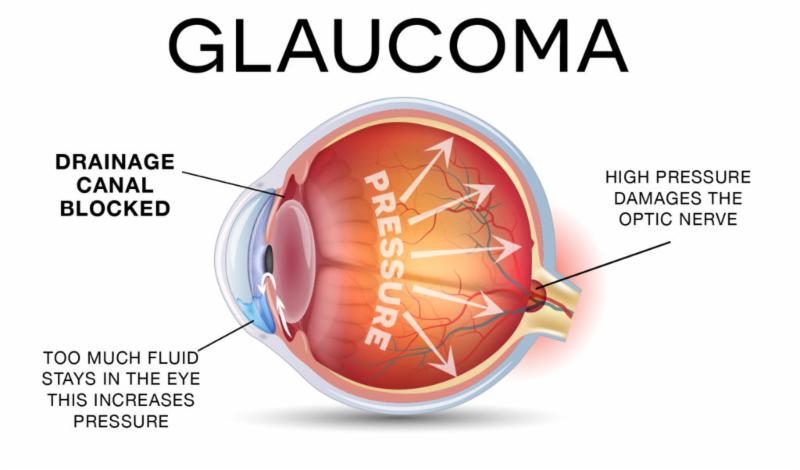 Glaucoma diagram