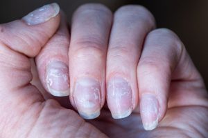 brittle fingernails